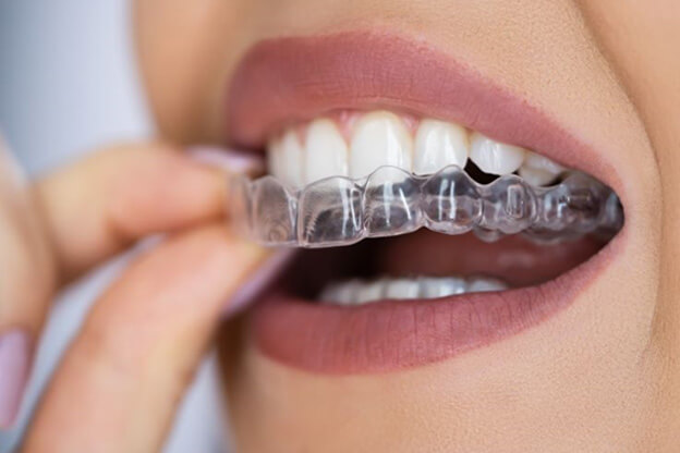 close-up of woman mouth as she places clear aligner on her teeth