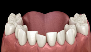 illustration of crowded teeth viewed from the front