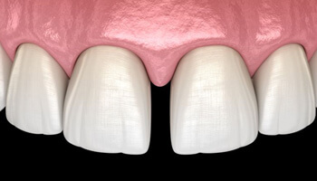 illustration of gap between front teeth