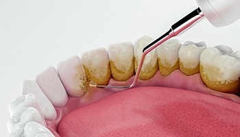 a 3D illustration of the scaling and root planing process